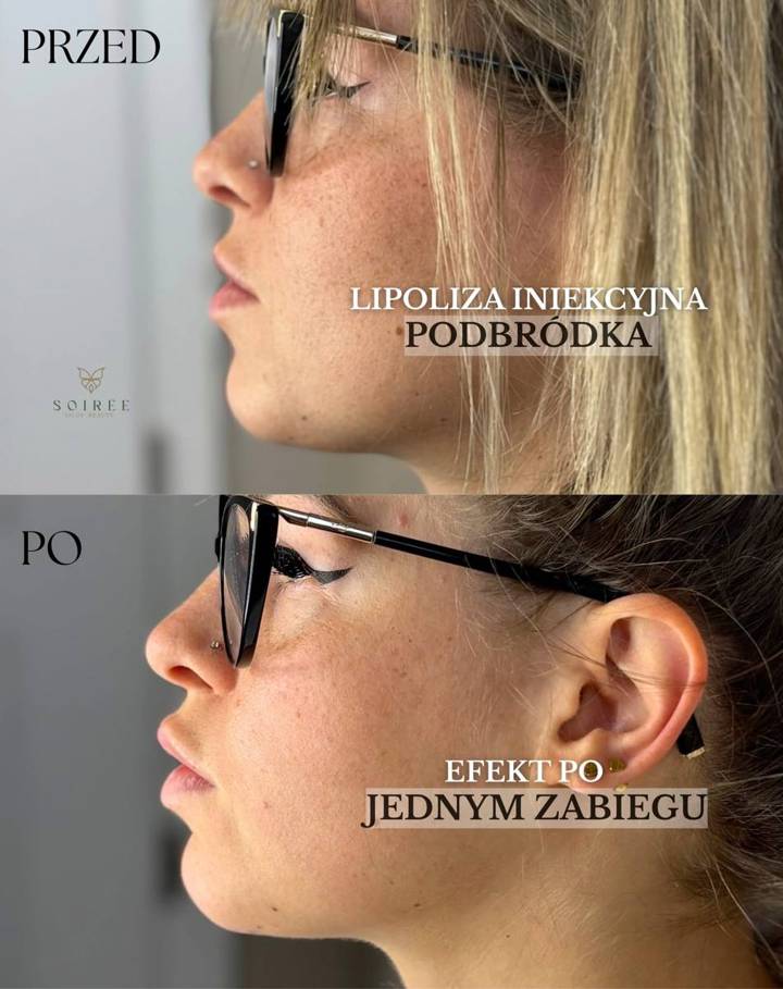 Lipoliza podbródka – przed i po – SOIRÉE Szczecin