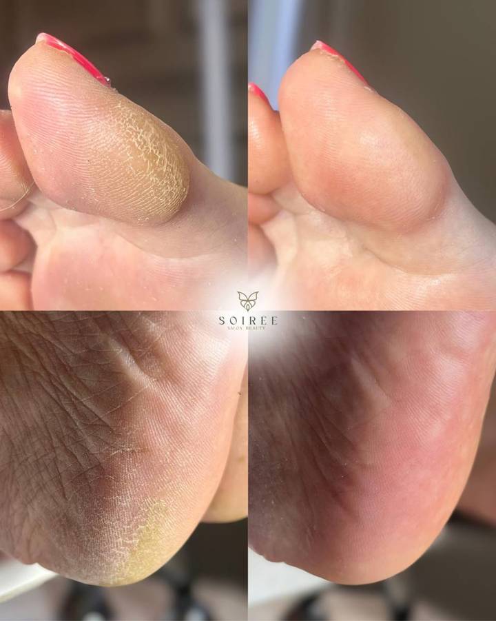 Pedicure kosmetyczny – przed i po – SOIRÉE Szczecin